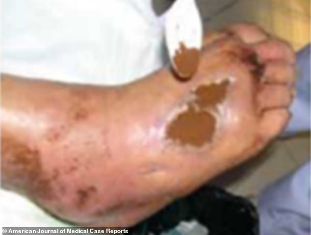 A 63-year-old man in West Java had three diabetic ulcers on the top of his right foot covered with powdered coffee by doctors after he refused to have an amputation